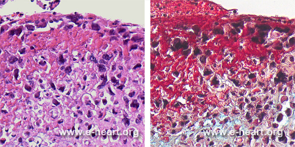 Intimal sarcoma - High Mag